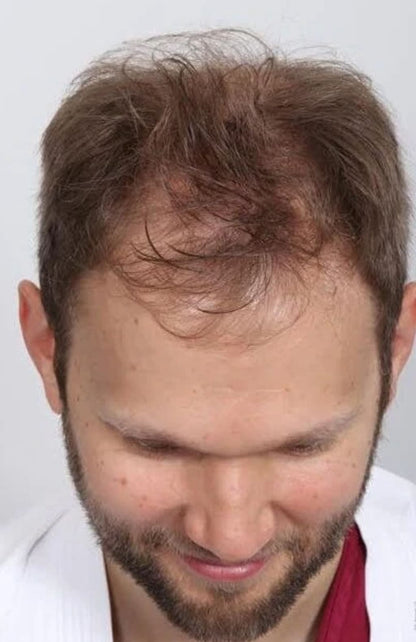 NaturaGrow™ – Hair Awakening Roll-On